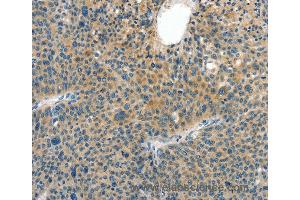 Immunohistochemistry of Human thyroid cancer using CRLF2 Polyclonal Antibody at dilution of 1:60 (CRLF2 抗体)
