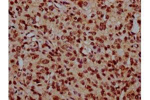 IHC image of ABIN7162006 diluted at 1:300 and staining in paraffin-embedded human glioma performed on a Leica BondTM system. (TMEM48 抗体  (AA 385-517))