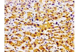 Immunohistochemistry of paraffin-embedded human liver cancer using ABIN7164629 at dilution of 1:100 (USP9X 抗体  (C-Term))