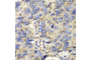 Immunohistochemistry of paraffin-embedded human liver cancer using SDHA antibody at dilution of 1:100 (400x lens). (SDHA 抗体)
