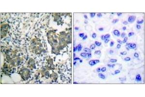 Immunohistochemistry analysis of paraffin-embedded human breast carcinoma tissue, using Keratin 8 (Ab-73) Antibody. (KRT8 抗体  (AA 41-90))