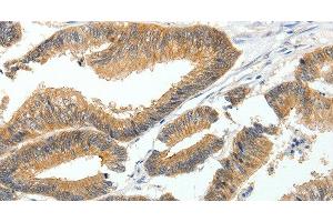 Immunohistochemistry of paraffin-embedded Human colon cancer tissue using MDK Polyclonal Antibody at dilution 1:60 (Midkine 抗体)