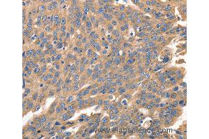 Immunohistochemistry of Human ovarian cancer using IRF1 Polyclonal Antibody at dilution of 1:40
