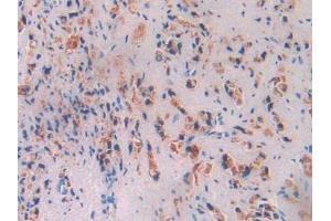 IHC-P analysis of Human Prostate Gland Cancer Tissue, with DAB staining. (Butyrylcholinesterase 抗体  (AA 29-150))