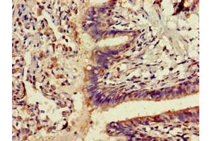 Immunohistochemistry of paraffin-embedded human lung cancer using ABIN7143291 at dilution of 1:100 (ADK 抗体  (AA 18-256))
