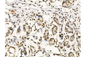 Phospho-Foxp3 (Ser19) Antibody at 1/100 staining Human pancreatic cancer by IHC-P. (FOXP3 抗体  (pSer19))