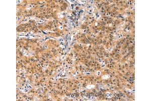 Immunohistochemistry of Human gastric cancer using EIF4G1 Polyclonal Antibody at dilution of 1:30 (EIF4G1 抗体)