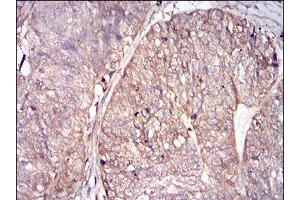 Immunohistochemical analysis of paraffin-embedded ovarian cancer tissues using FTL mouse mAb with DAB staining. (FTL 抗体  (AA 1-175))