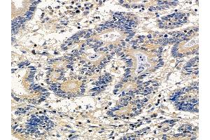 ABIN6260104 and ABIN6278139 at 1/100 staining human colorectal cancer by IHC-P.
