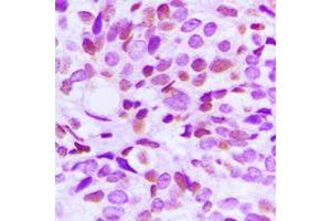Immunohistochemical analysis of BRAF35 staining in human breast cancer formalin fixed paraffin embedded tissue section. (HMG20B 抗体  (N-Term))