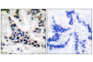 Immunohistochemical analysis of paraffin-embedded human lung carcinoma tissue, using HDAC1 antibody (ABIN5976420). (HDAC1 抗体  (C-Term))