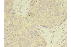 Immunohistochemistry of paraffin-embedded human gastric cancer using ABIN7175049 at dilution of 1:100 (C2ORF69 抗体  (AA 117-269))