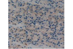 IHC-P analysis of Human Prostate Gland Cancer Tissue, with DAB staining. (PLAT 抗体  (AA 311-562))