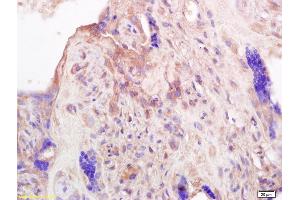Formalin-fixed and paraffin embedded human placenta labeled with Anti-PRL Polyclonal Antibody, Unconjugated (ABIN669456) at 1:200 followed by conjugation to the secondary antibody and DAB staining. (Prolactin 抗体  (AA 165-227))
