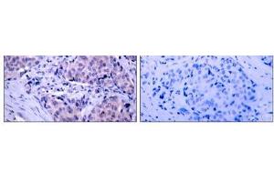 Immunohistochemical analysis of paraffin- embedded human breast carcinoma tissue using PDK1 (Ab-241) antibody (E021005). (PDPK1 抗体)