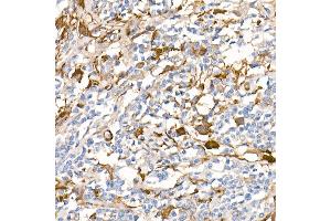 Immunohistochemistry of paraffin-embedded Human Hodgkin lymphoma (positive control antibody staining, clone 55k-2) using Fascin/FSCN1 antibody (ABIN7267142) at dilution of 1:100 (40x lens). (Fascin 抗体)