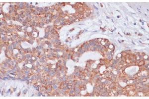Immunohistochemistry of paraffin-embedded Human breast cancer using KCNH2 Polyclonal Antibody at dilution of 1:100 (40x lens). (KCNH2 抗体)