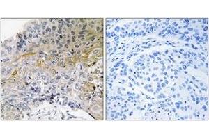 Immunohistochemistry analysis of paraffin-embedded human breast carcinoma tissue, using p130 Cas (Ab-410) Antibody. (BCAR1 抗体  (AA 376-425))