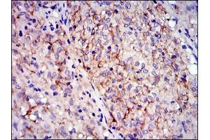 Immunohistochemical analysis of paraffin-embedded gastrointestinal stromal tumor using KIT mouse mAb with DAB staining. (KIT 抗体)