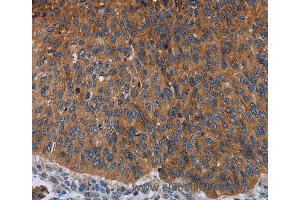 Immunohistochemistry of Human lung cancer using JUP Polyclonal Antibody at dilution of 1:50 (JUP 抗体)