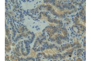 Detection of P-cadherin in Human Thyroid cancer Tissue using Polyclonal Antibody to Placental Cadherin (P-cadherin) (P-Cadherin 抗体  (AA 371-660))