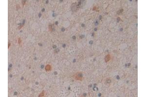 DAB staining on IHC-P; Samples: Human Glioma Tissue (CNTNAP4 抗体  (AA 706-886))