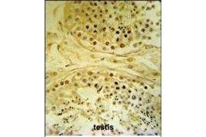 I Antibody (C-term) (ABIN653307 and ABIN2842806) IHC analysis in formalin fixed and paraffin embedded human testis carcinoma followed by peroxidase conjugation of the secondary antibody and DAB staining. (IMP4 抗体  (C-Term))