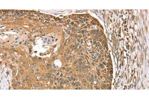 Immunohistochemistry of paraffin-embedded Human esophagus cancer using MORF4L1 Polyclonal Antibody at dilution of 1:35 (MORF4L1 抗体)