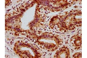 IHC image of ABIN7127685 diluted at 1:100 and staining in paraffin-embedded human breast cancer performed on a Leica BondTM system. (Recombinant CREB1 抗体  (pSer133))