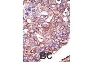Formalin-fixed and paraffin-embedded human cancer tissue reacted with SYVN1 polyclonal antibody  , which was peroxidase-conjugated to the secondary antibody, followed by DAB staining. (SYVN1 抗体  (C-Term))