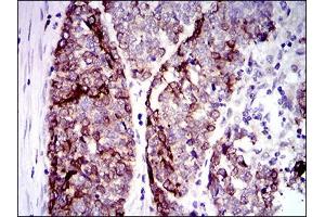 Immunohistochemical analysis of paraffin-embedded esophageal cancer tissues using CK5 mouse mAb with DAB staining. (Cytokeratin 5 抗体  (AA 316-590))