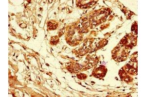 Immunohistochemistry of paraffin-embedded human breast cancer using ABIN7144028 at dilution of 1:100 (Amphiregulin 抗体  (AA 107-148))