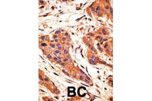 Formalin-fixed and paraffin-embedded human breast cancer tissue reacted with SNAI1 polyclonal antibody  , which was peroxidase-conjugated to the secondary antibody, followed by AEC staining. (SNAIL 抗体  (AA 9-39))