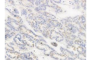 ABIN6255629 and ABIN6267394 at 1/100 staining human renal cell carcinoma by IHC-P. (RPA2 抗体  (pThr21))