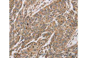 Immunohistochemistry of Human lung cancer using PTGER2 Polyclonal Antibody at dilution of 1:45 (PTGER2 抗体)