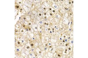 Immunohistochemistry of paraffin-embedded human liver injury using RAD9A antibody. (RAD9A 抗体)