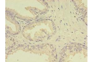 Immunohistochemistry of paraffin-embedded human prostate cancer using ABIN7159642 at dilution of 1:100 (MTHFR 抗体  (AA 1-656))