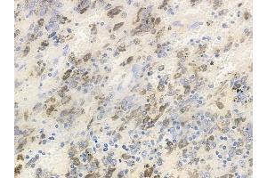 ABIN6256451 and ABIN6267428 at 1/100 staining human melanoma by IHC-P.