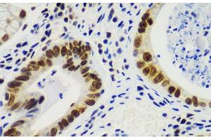 Immunohistochemistry of paraffin-embedded Human gastric cancer using RNF2 Polyclonal Antibody at dilution of 1:100 (40x lens). (RNF2 抗体)