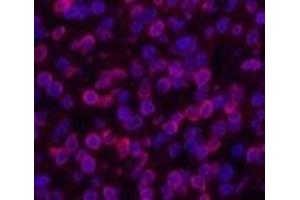 Immunofluorescence analysis of Human lung cancer tissue using Lamin B1 Monoclonal Antibody at dilution of 1:200. (Lamin B1 抗体)