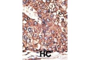 Formalin-fixed and paraffin-embedded human cancer tissue reacted with the primary antibody, which was peroxidase-conjugated to the secondary antibody, followed by DAB staining. (Leptin Receptor 抗体  (N-Term))