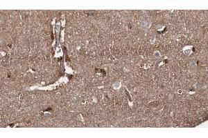 ABIN6279190 at 1/100 staining Human brain cancer tissue by IHC-P. (B4GALT7 抗体)