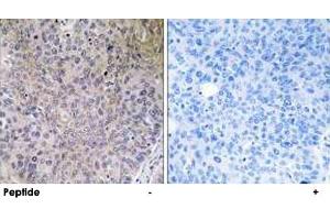 Immunohistochemistry analysis of paraffin-embedded human lung carcinoma tissue using NDUFS7 polyclonal antibody . (NDUFS7 抗体)
