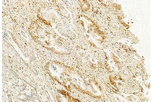 ABIN6262478 and ABIN6272858 at 1/100 staining Human pancreatic cancer by IHC-P. (IFT20 抗体  (N-Term))