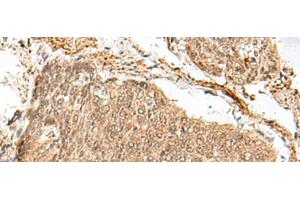 Immunohistochemistry of paraffin-embedded Human esophagus cancer tissue using GEMIN4 Polyclonal Antibody at dilution of 1:30(x200) (GEMIN4 抗体)