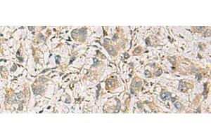 Immunohistochemistry of paraffin-embedded Human liver cancer tissue using CMTM1 Polyclonal Antibody at dilution of 1:40(x200) (CMTM1 抗体)