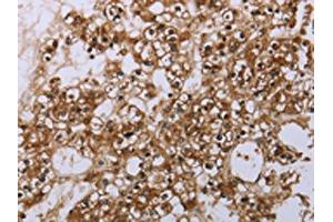 The image is immunohistochemistry of paraffin-embedded human prostate cancer tissue using ABIN7190062(CASP8AP2 Antibody) at dilution 1/20. (FLASH 抗体)