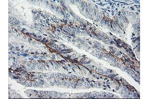 Immunohistochemical staining of paraffin-embedded Adenocarcinoma of Human endometrium tissue using anti-DTNB mouse monoclonal antibody. (Dystrobrevin beta 抗体)