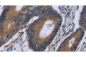 Immunohistochemistry of paraffin-embedded Human colon cancer using IPO4 Polyclonal Antibody at dilution of 1:50 (Importin 4 抗体)