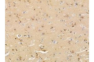 ABIN6265624 and ABIN6266916 at 1/100 staining human glioblastoma by IHC-P. (TNFAIP2 抗体  (N-Term))
